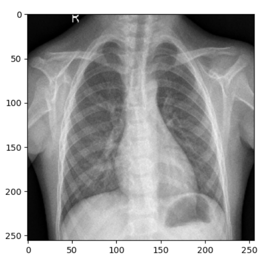 Pneumonia Infected Chest - Geeksforgeeks