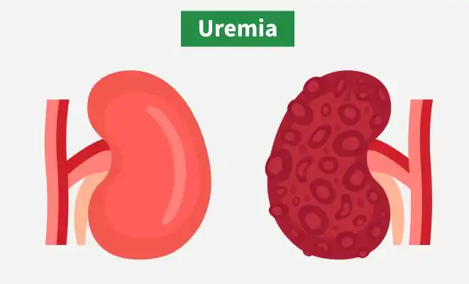 uremia