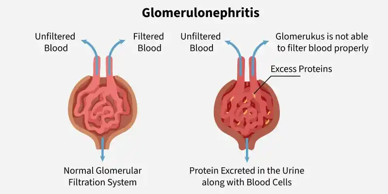 glomerulonephritis
