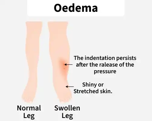 oedema