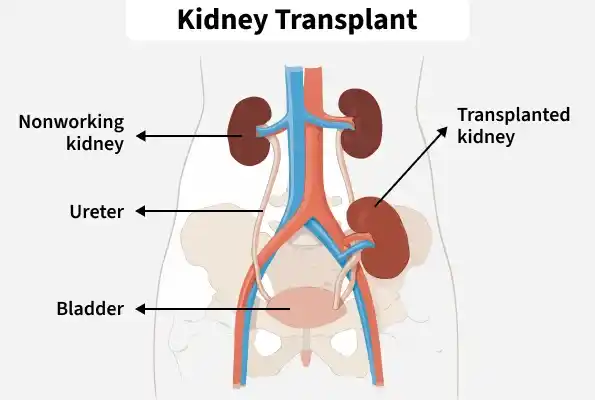 kidney_transplant
